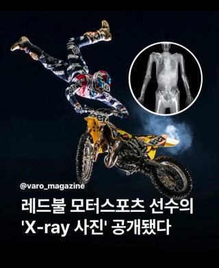 레드불 모터스포츠 선수의 X레이 사진